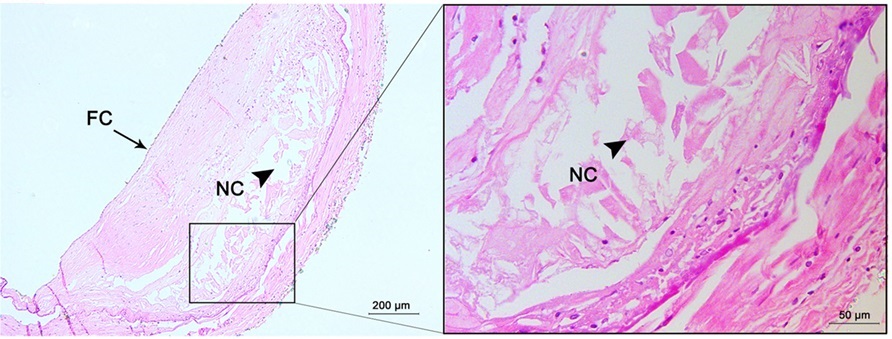 File:Histopathology of progressive atherosclerotic lesion with fibrous cap  and necrotic core.jpg - Wikimedia Commons