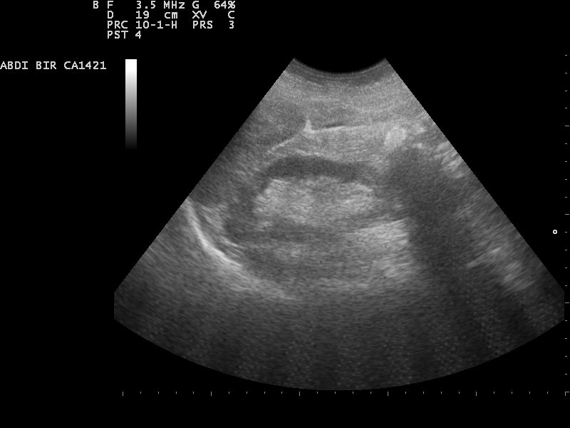 File:Kidney ultrasound 110321154951 1551150.jpg