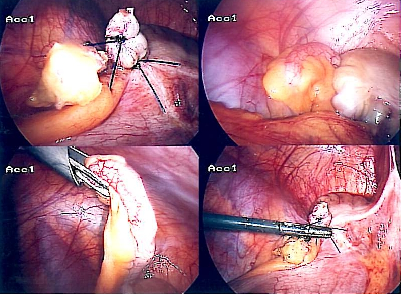 File:Appendix-Entfernung.jpg