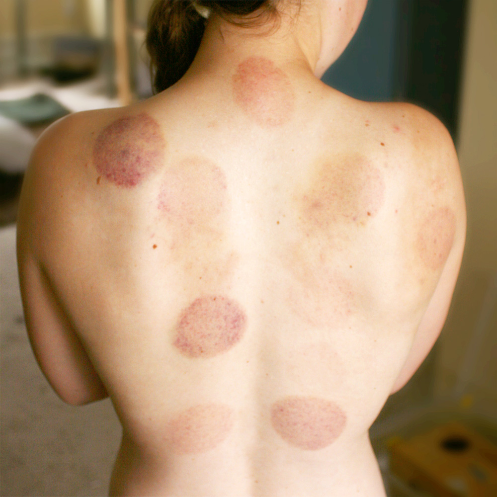 File:Bruising on back from Cupping.jpg - Wikimedia Commons