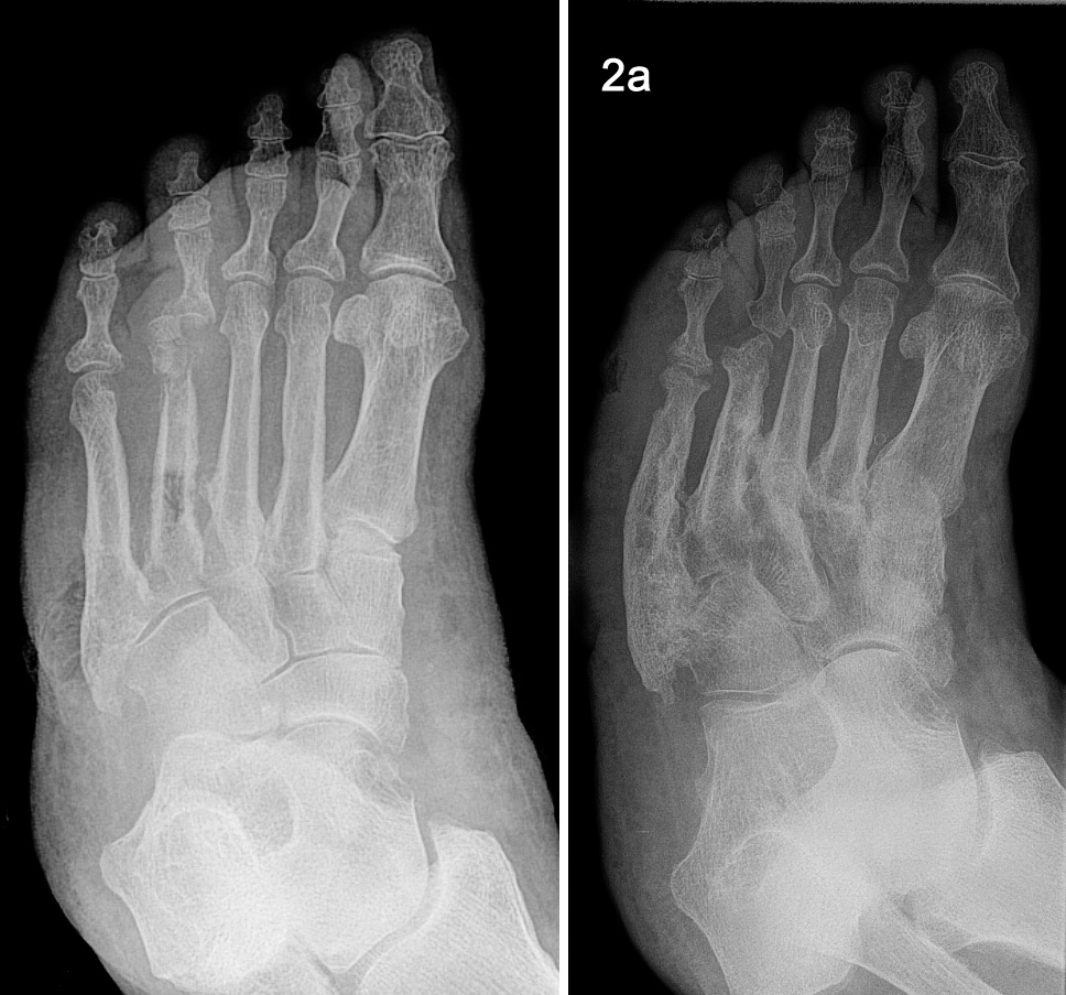 icd 10 code for diabetic ulcer with osteomyelitis)