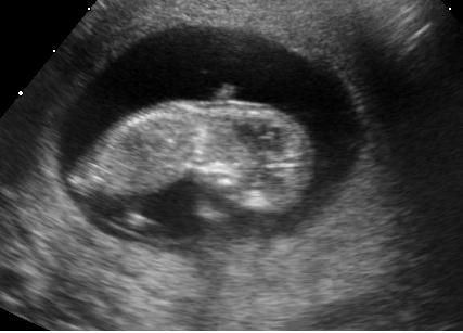 Fichier Embryo At 11 Weeks Jpg Wikipedia