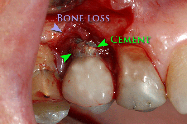 Periimplantitis due to dental cement