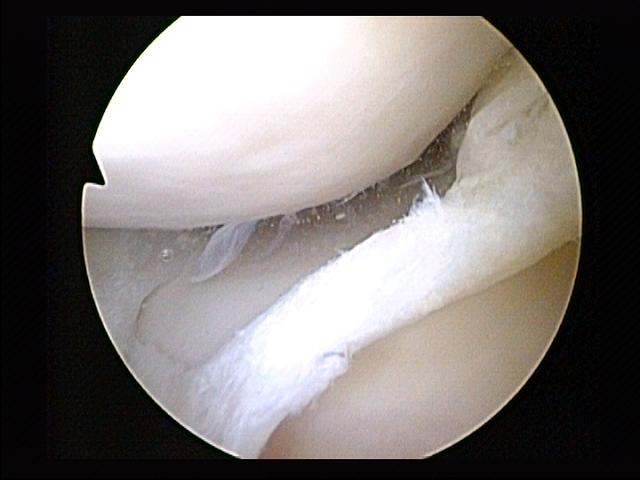 File:Tear of medial meniscus.jpg