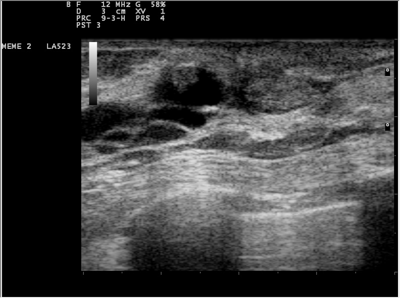 intraductal papilloma ultrasound)