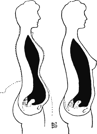 File:Antero-posterior section shape of cavities with and without corsets.gif  - Wikimedia Commons