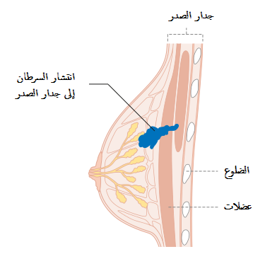 File:Diagram 1 of 2 showing stage 3B breast cancer CRUK 004-ar.png