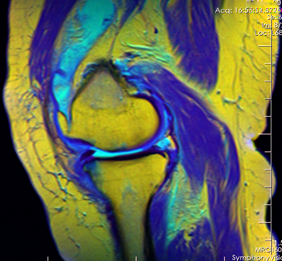 File:Knee MRI 113247 rgbcc.png