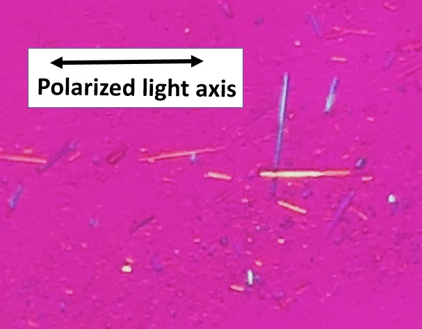 gout vs pseudogout crystals