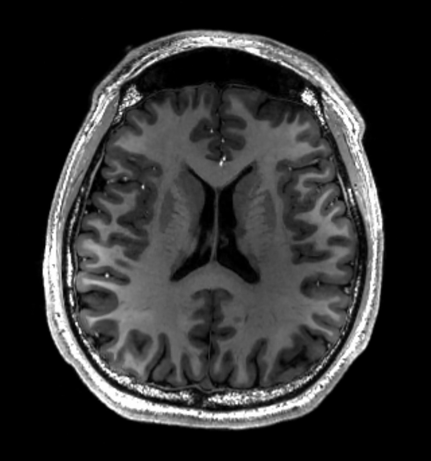 normal brain mri with contrast