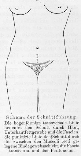 cesarean section incision types