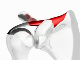 Shoulder pain when arms raised can be caused by impingement of the supraspinatus tendon