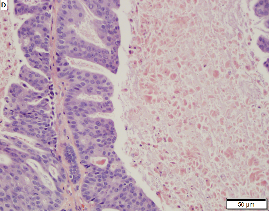 salivary duct carcinoma