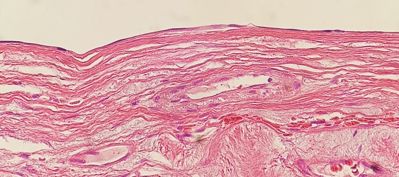 ovarian cyst histology