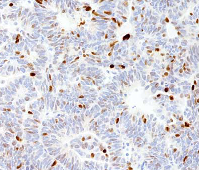 Immunohistochemistry of endometrial endometrioid carcinoma with wild-type pattern of p53 expression, with variable proportion of tumor cell nuclei staining with variable intensity