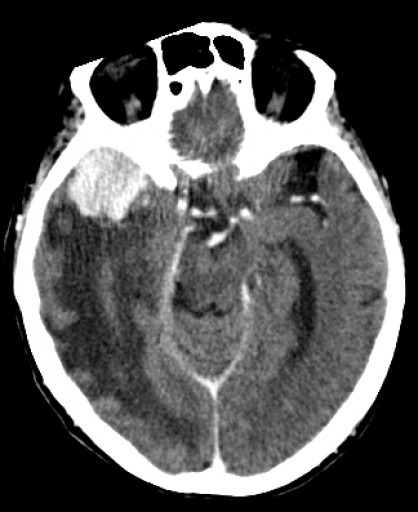 File:Keilbeinmeningeom mit Oedem - CT - axial mit KM - 005.jpg