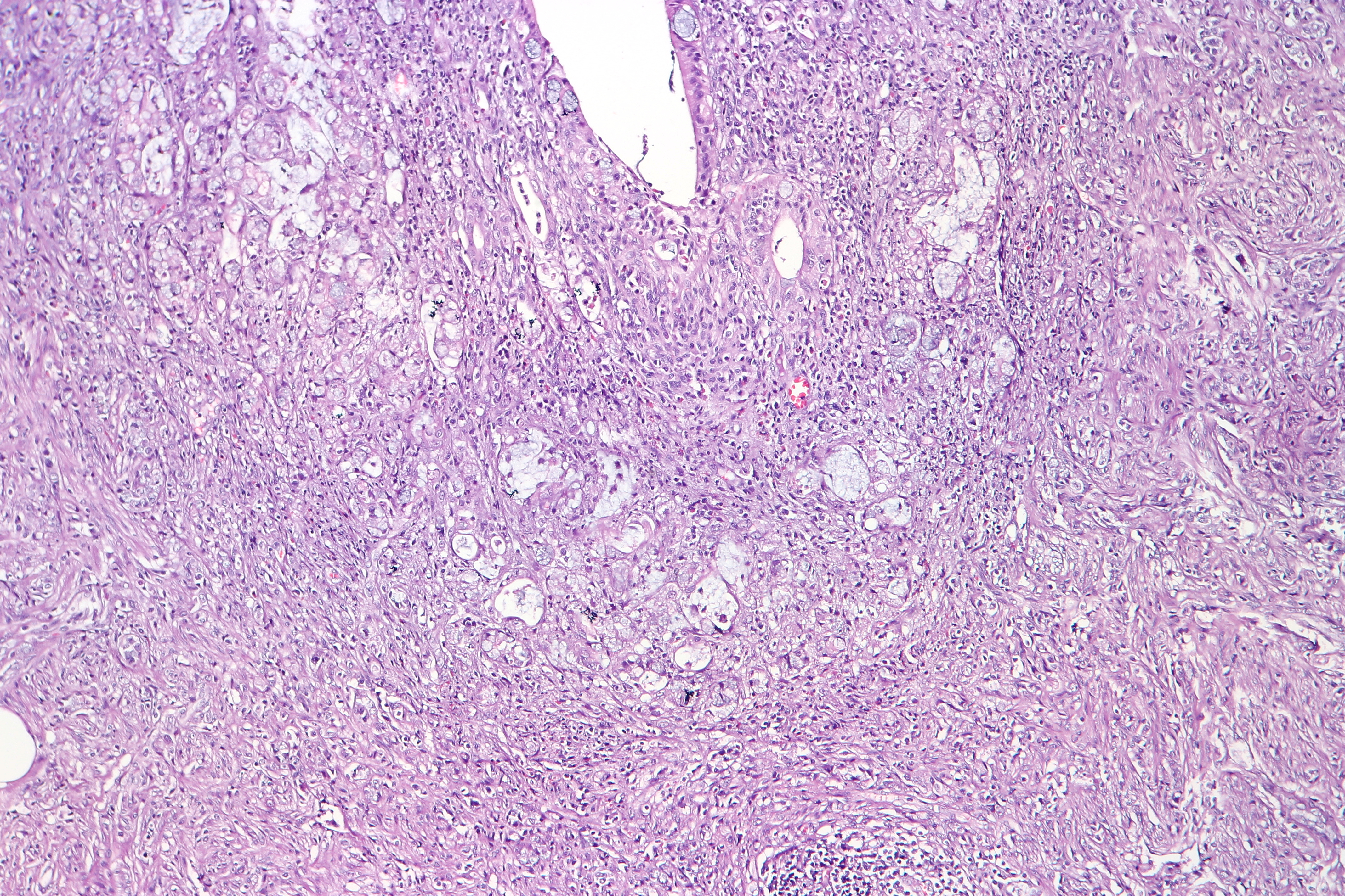 Multiple polypoid colonic metastases from rectal adenocarcinoma with signet  ring cells features: a case report | BMC Gastroenterology | Full Text