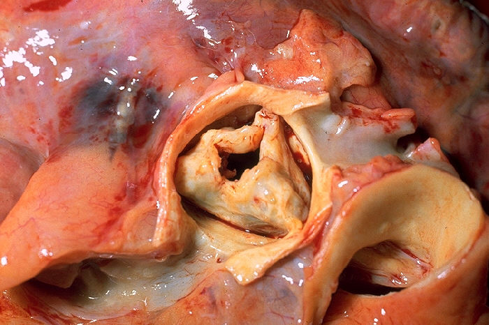 Aortic Stenosis-avatar