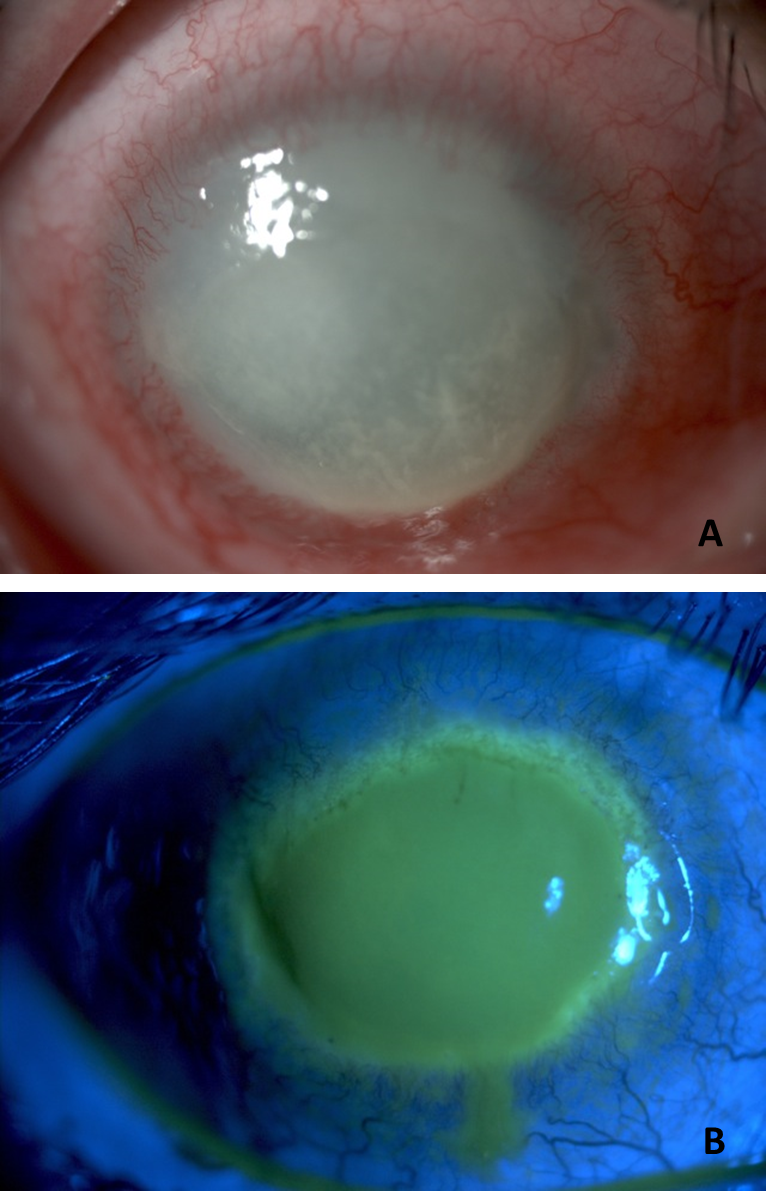 amoebic keratitis