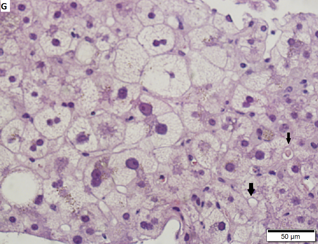 60 year old woman with poorly differentiated ampullary adenocarcinoma and obstructive cholestasis in liver