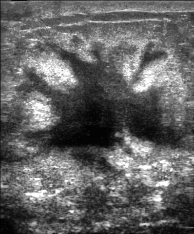 File:Breast cancer ultrasound.jpg