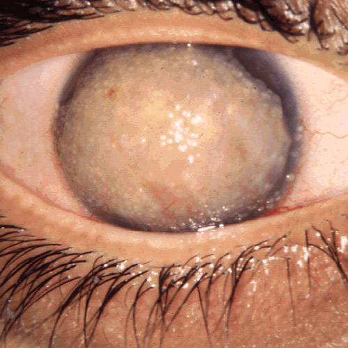 File:Gelatinous drop-like corneal dystrophy 1.JPEG