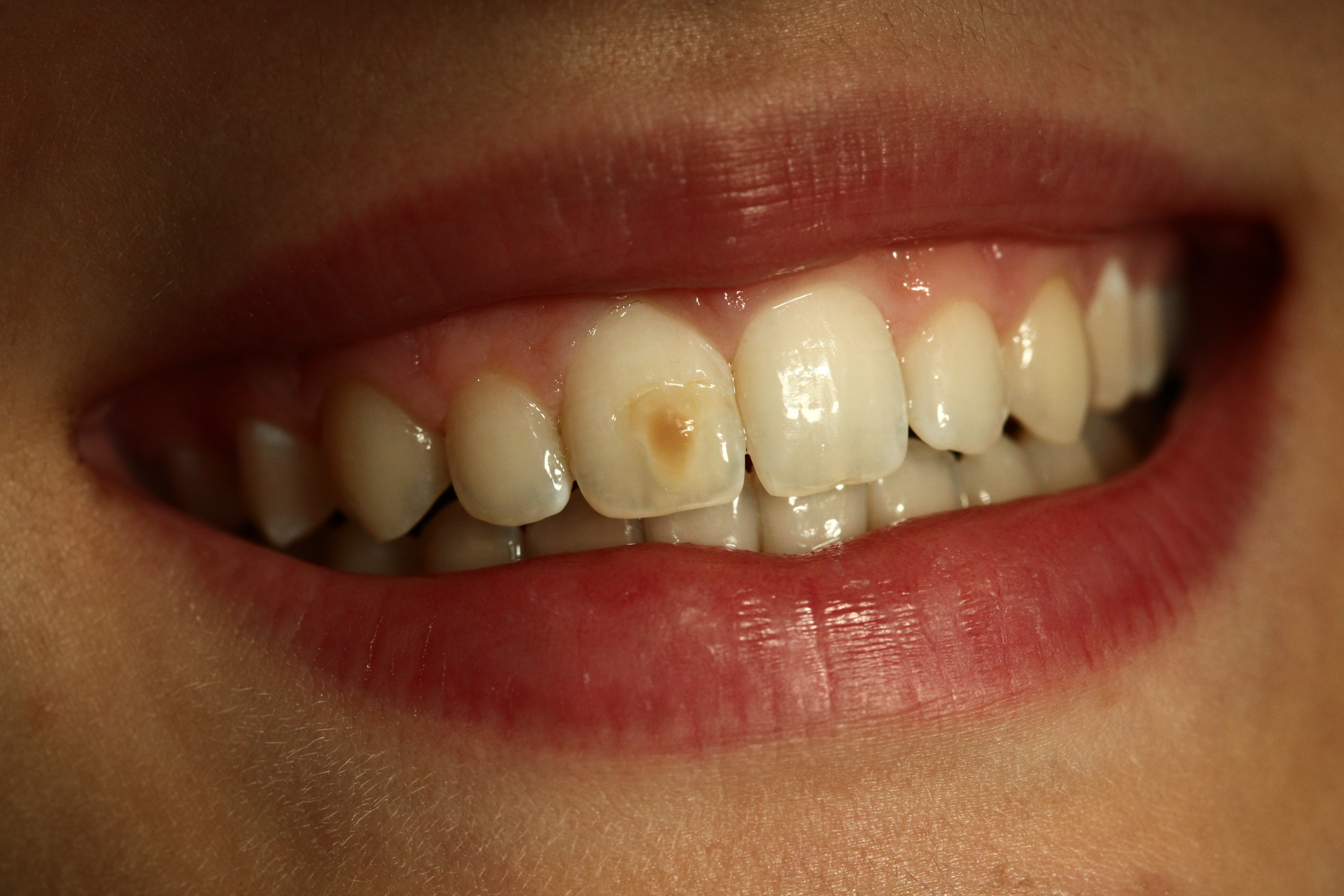 Zahn verfärbt sich grau