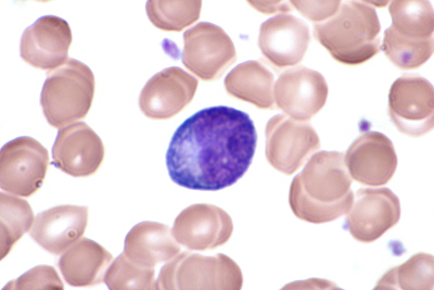 File:Activated lymphocytes-2.JPG