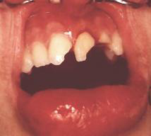 Graue stelle zahn Zähne graue