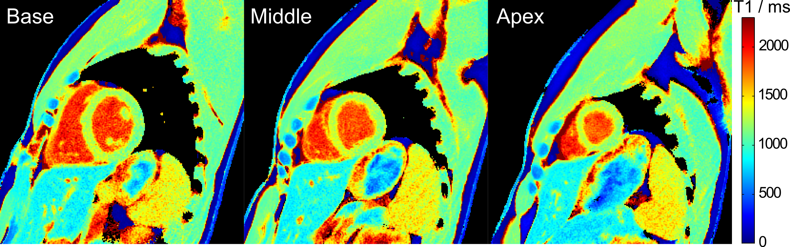 Base middle. T1 Mapping MRI.