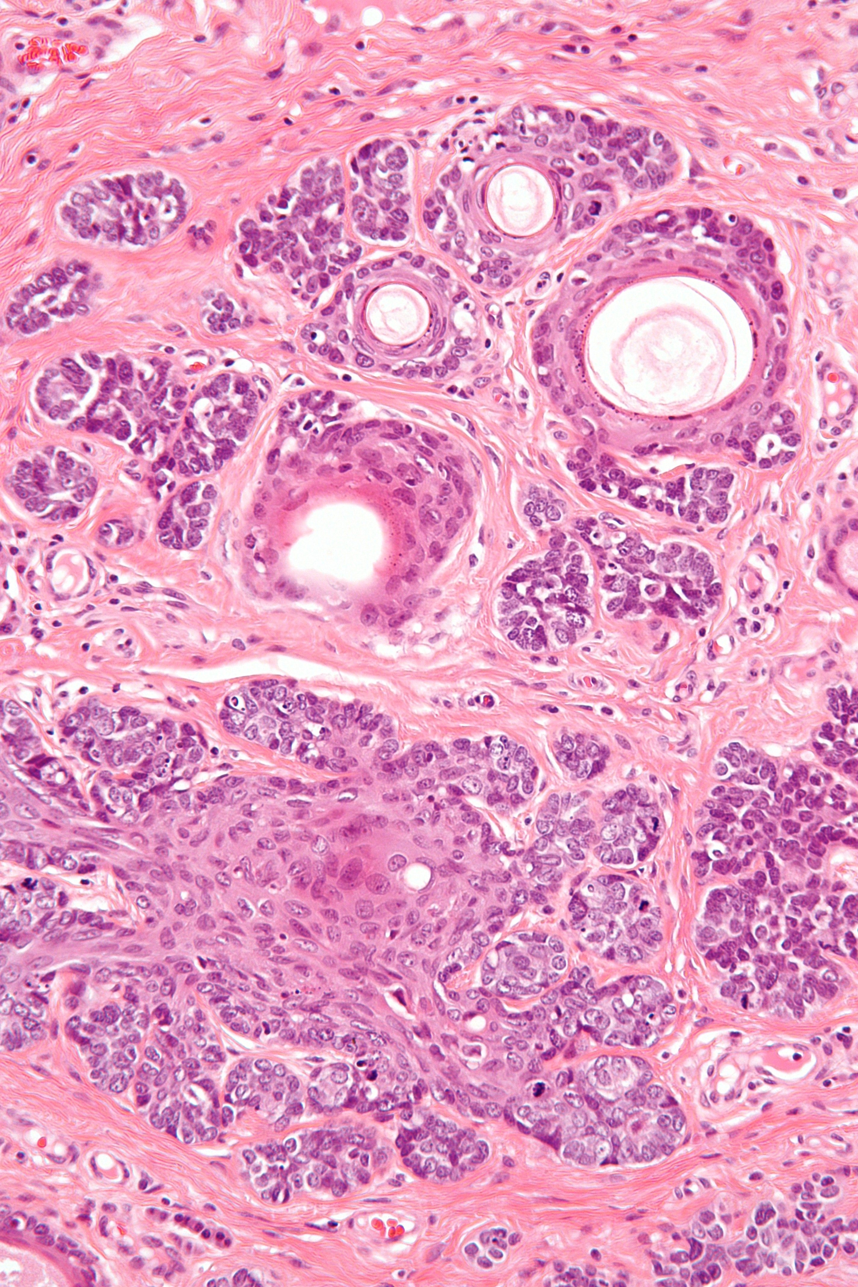 solitary trichoepithelioma