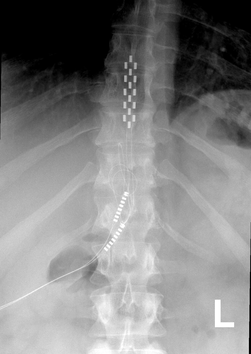 Spinal Cord Stimulator  Johns Hopkins Medicine