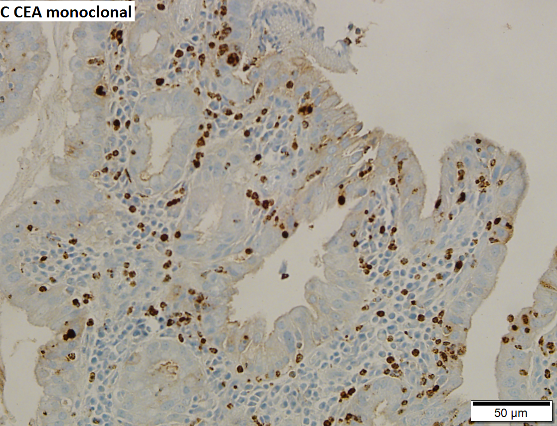 Chronic cholecystitis with reactive changes.