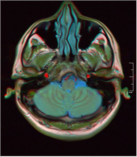 File:Brain MRI 0249 16.jpg