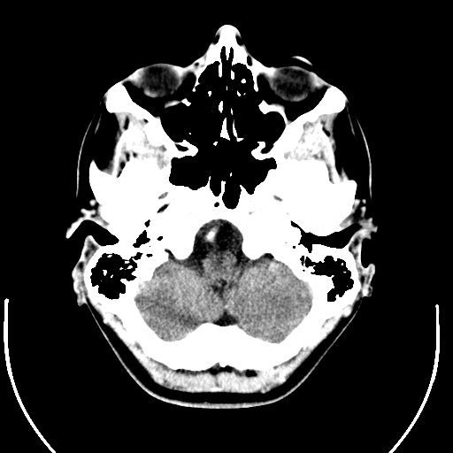 File:Computed tomography of human brain (4).png