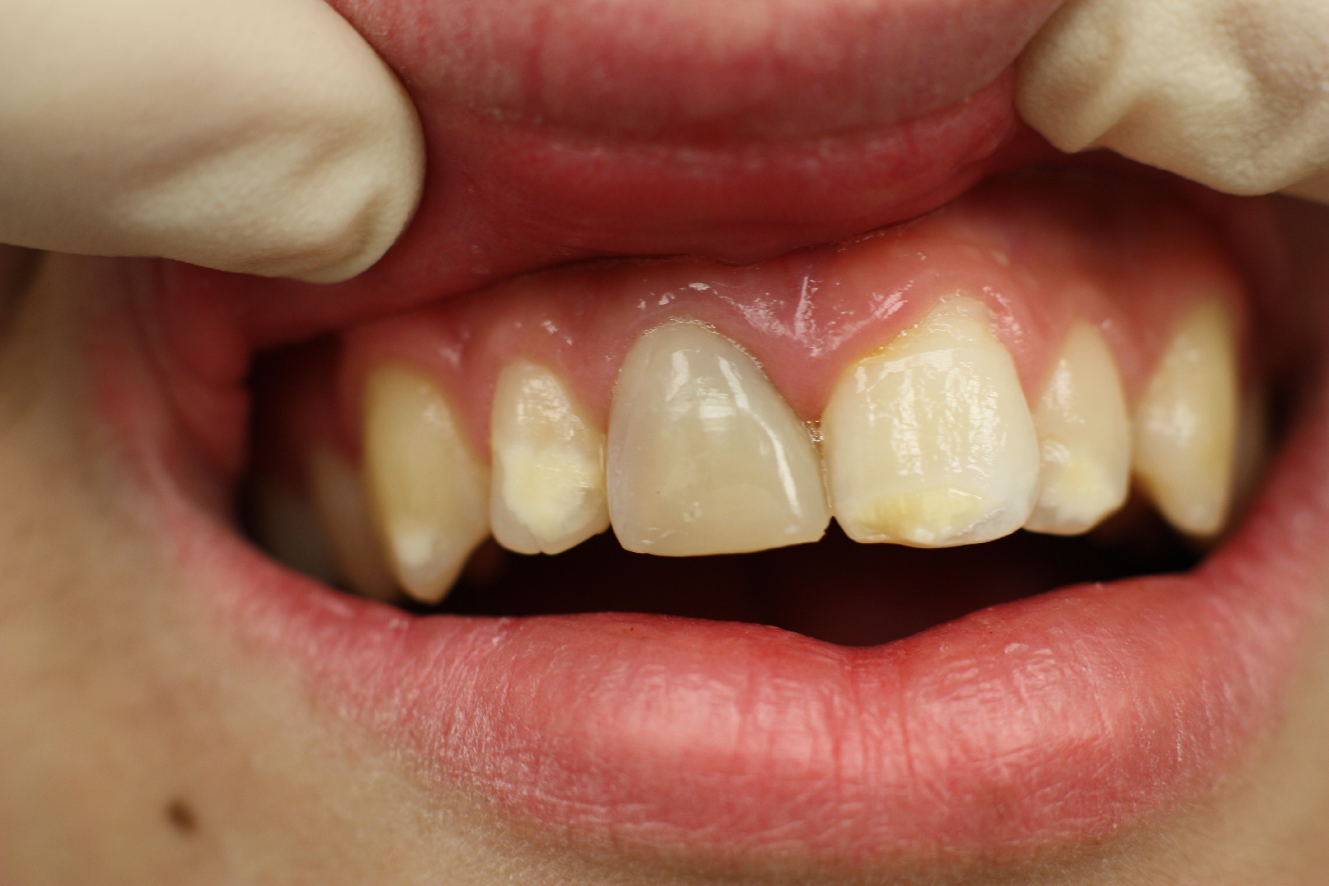 Wird grau zahn Zahn verfärbt