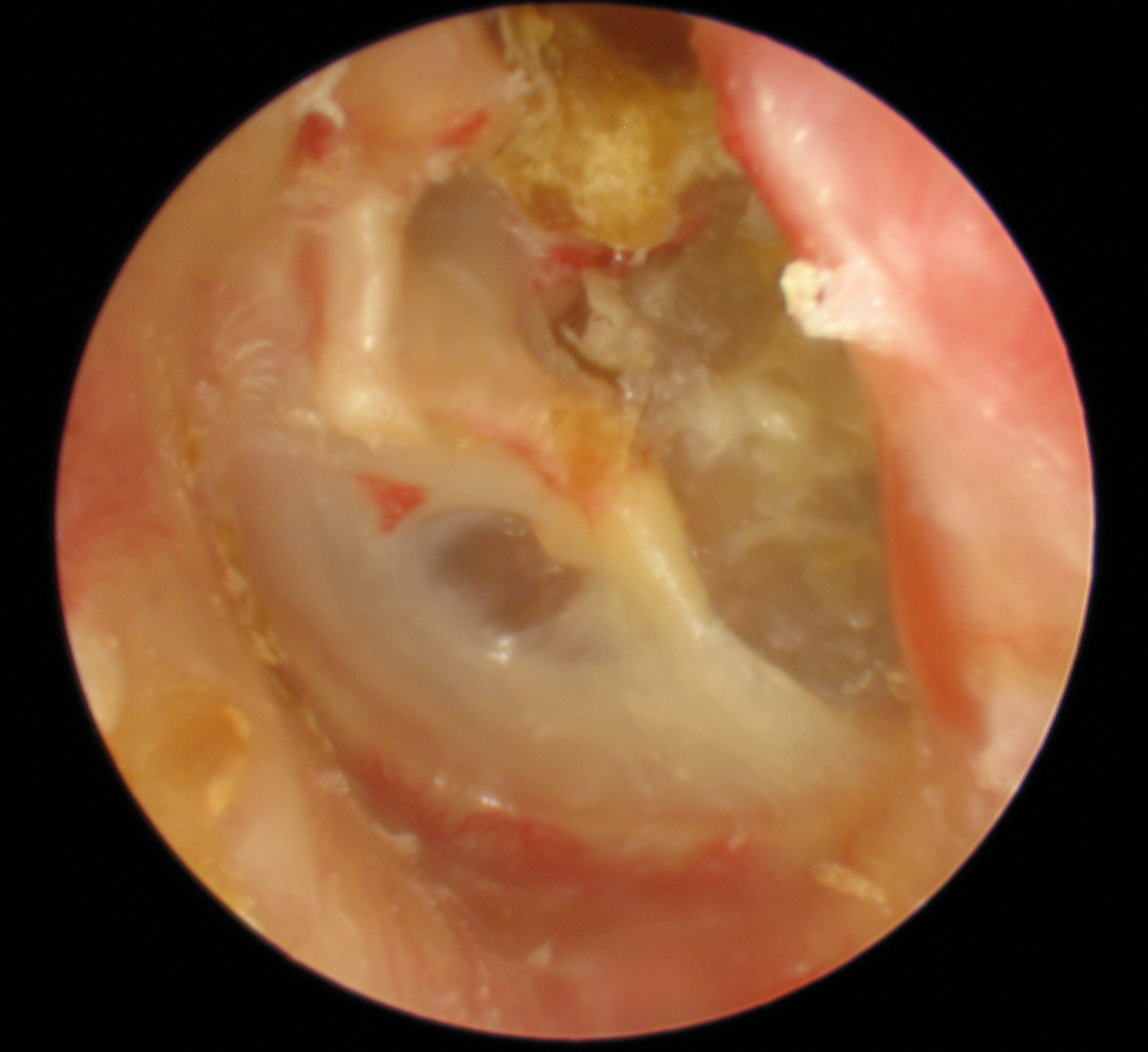 Cholesteatom – Wikipedia