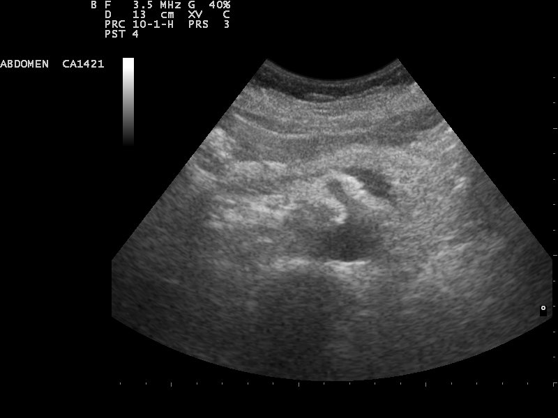 File:Ultrasound image of pancreas 110304153737 1538470.jpg