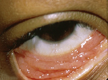 File:Chlamydial-conjunctivitis.jpg