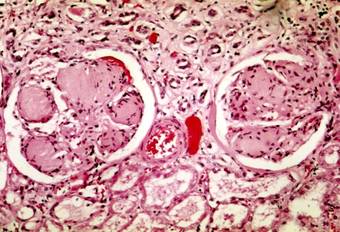 diabetes with ckd and neuropathy icd 10)