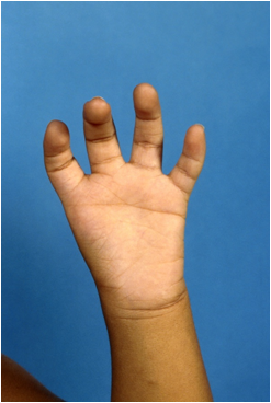 Hipoplasia del pulgar de tipo 5