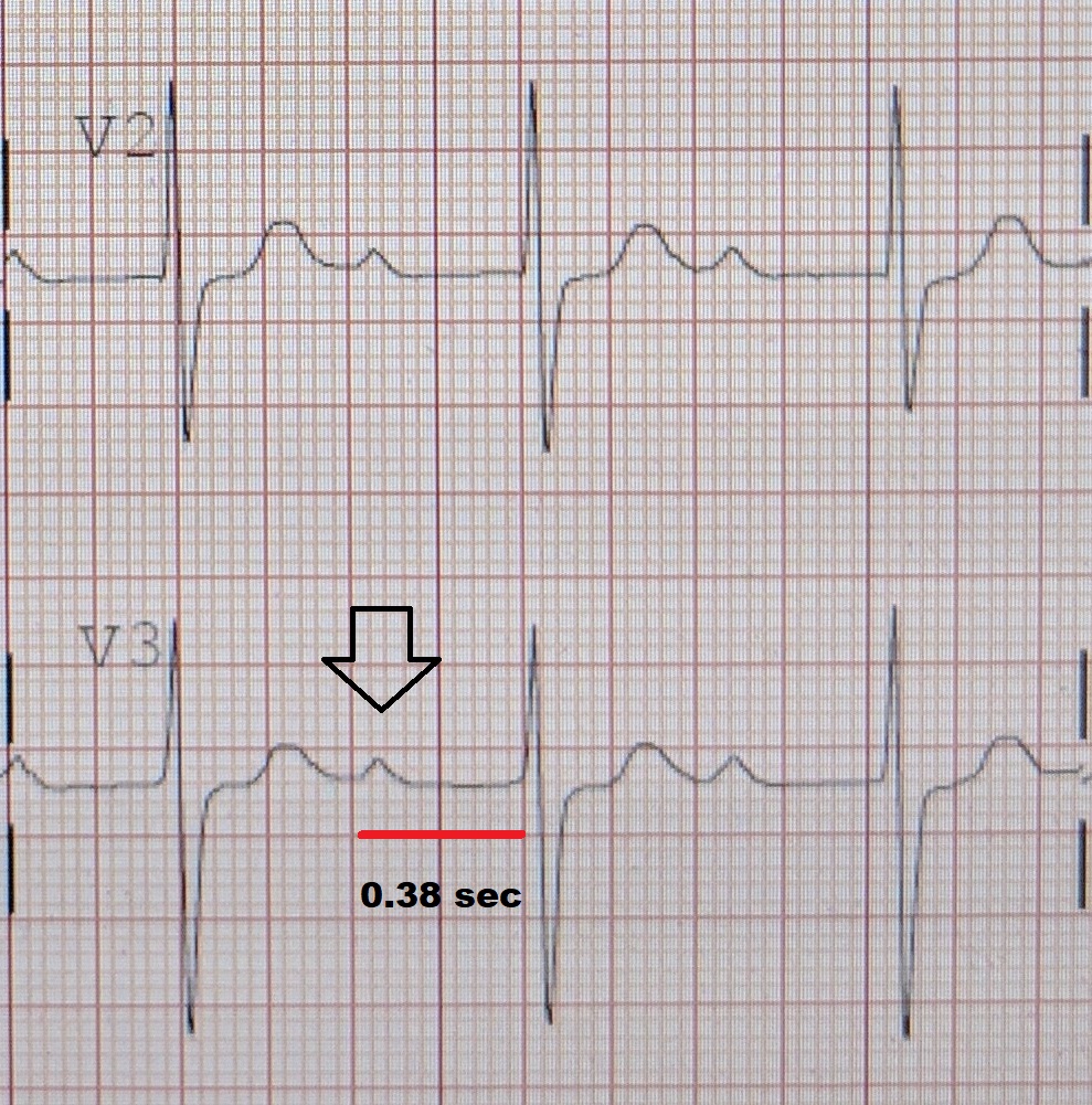 Atrioventricular Block, Heart Block