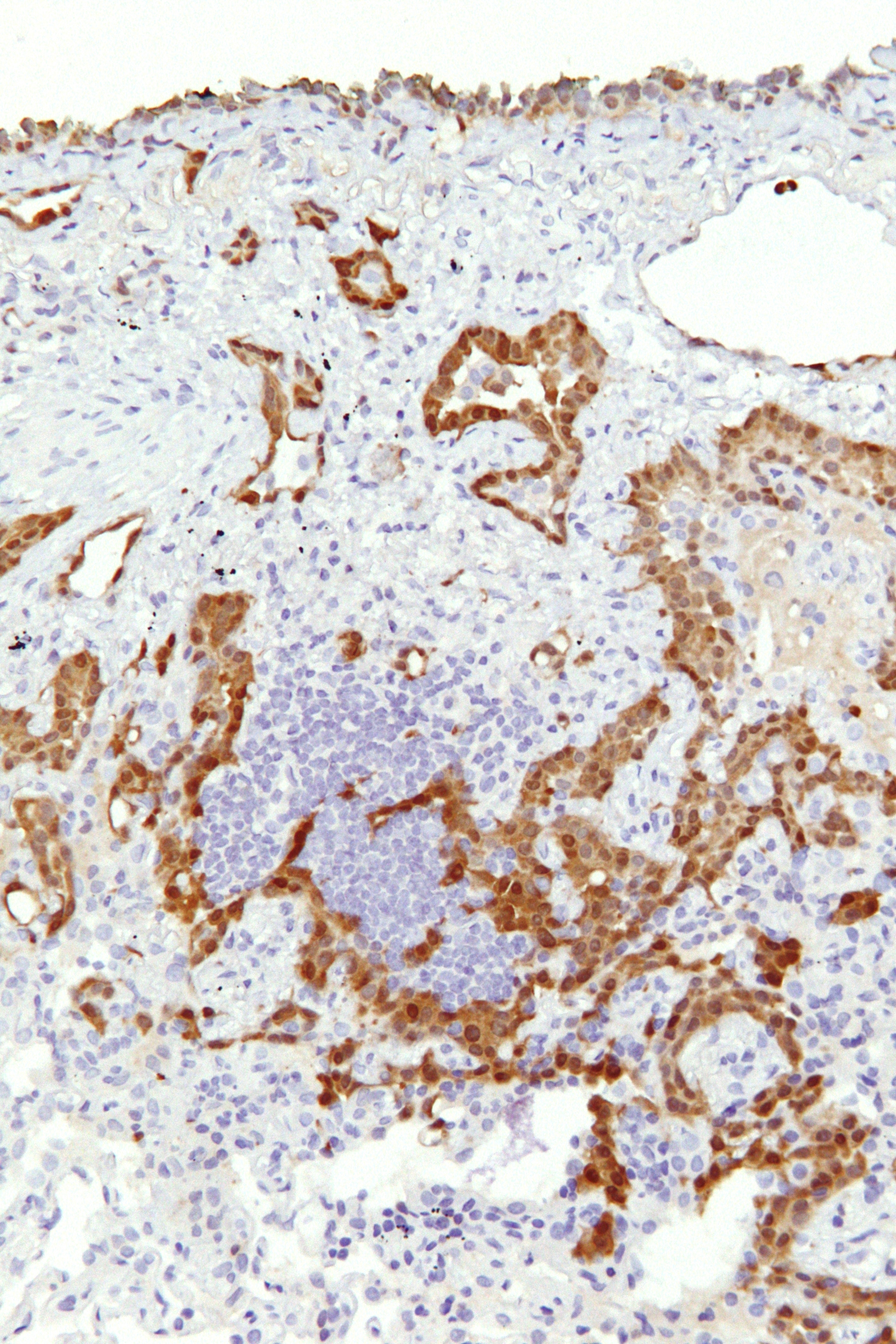 File:Malignant epithelioid mesothelioma - calretinin - high mag.jpg - Wikimedia Commons