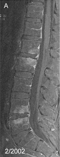 Spondylitis Tropheryma whipplei.jpg