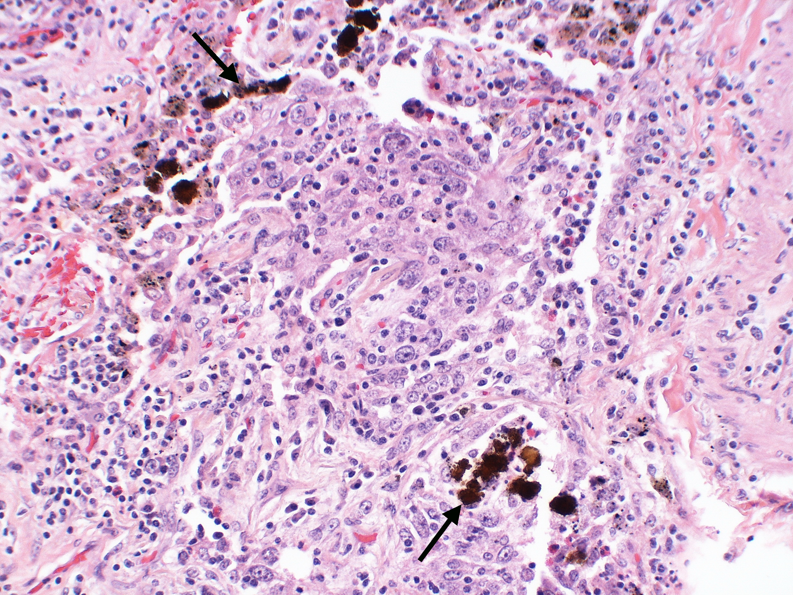 mesotelioma retroperitoneal radiopaedia