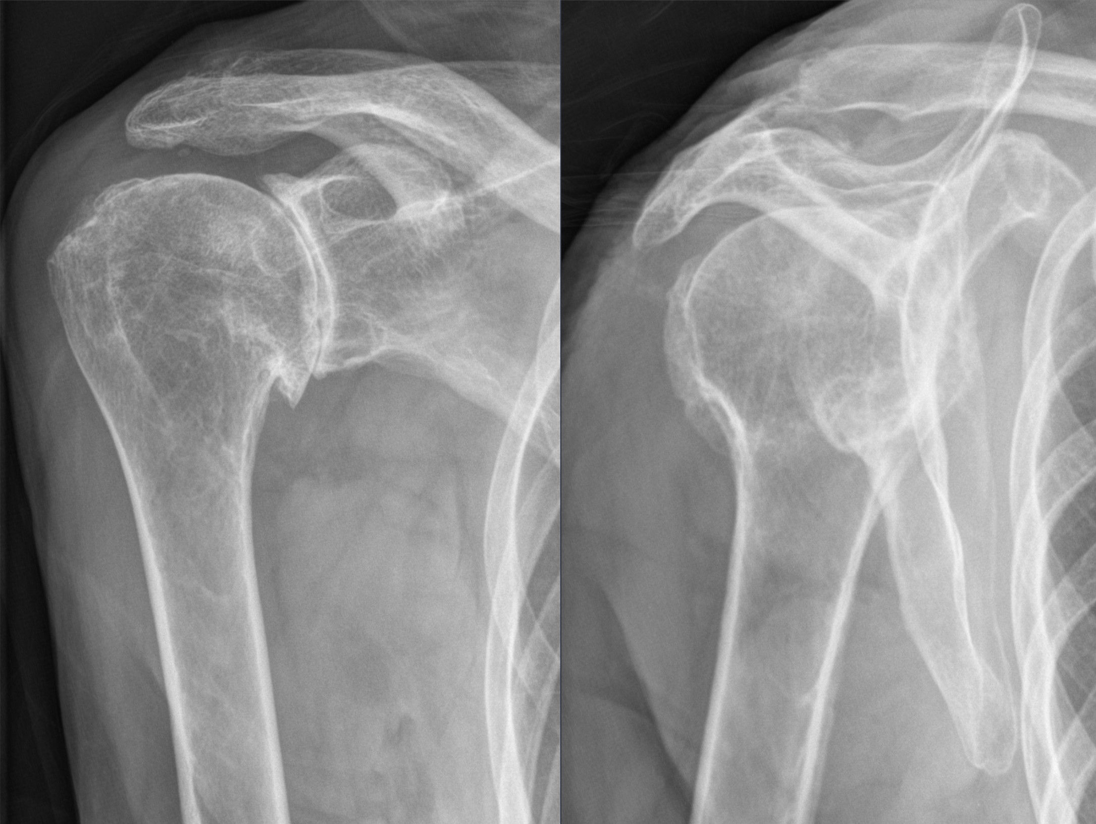 subchondral cyst