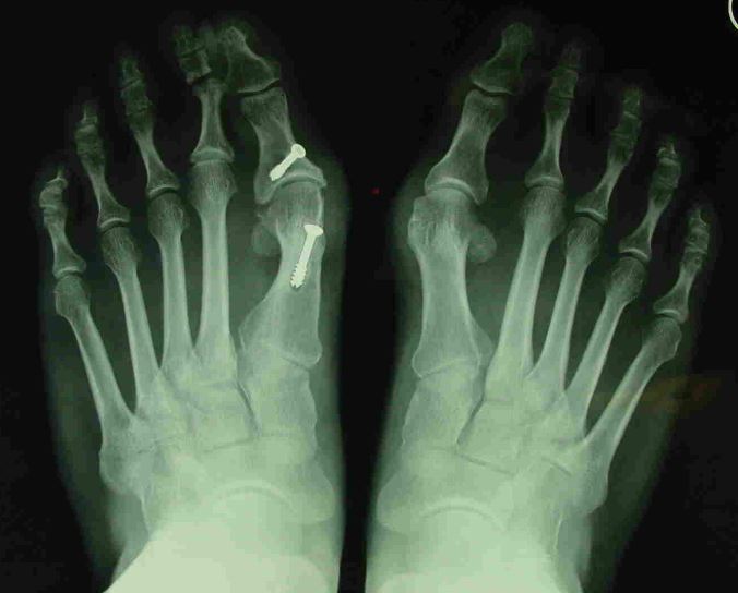 Painful hallux valgus.jpg