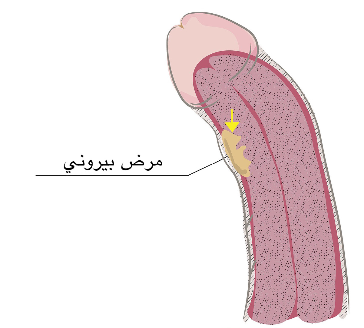 مرض بيروني