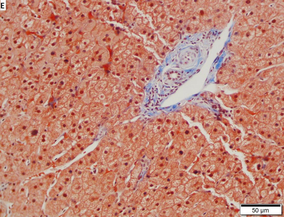 HBV Modified HAI necroinflammatory score 5, Modified HAI fibrosis stage 2