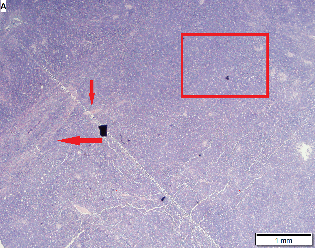 Thymoma type B1